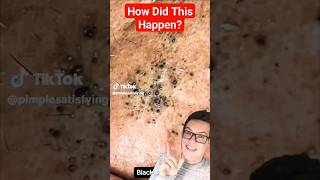 Crazy CLUSTER BLACKHEAD REMOVAL  Unbelievable shorts [upl. by Thaine]