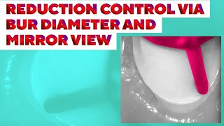 Reduction control via bur diameter and mirror view [upl. by Buhler]