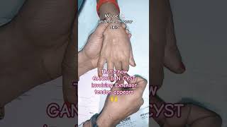 Ganglion cyst shorts mbbs neet trending viralvideos [upl. by Kirk]