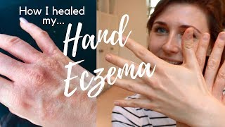 Hand Eczema Treatment Natural Cure  7 Tips How I Healed My Hand ECZEMA  HEAL ECZEMA NATURALLY [upl. by Eillak]