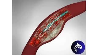 Quick View  Angioplasty and Stent Placement [upl. by Recnal]