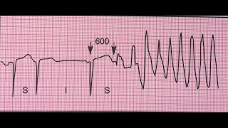 Torsades de pointes tachycardie ventriculaire [upl. by Rivera]