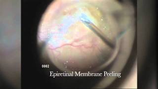 Epiretinal Membrane Peel ERM Barnet Dulaney Perkins Eye Center [upl. by Nottap]