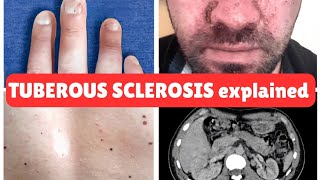 Tuberous Sclerosis Complex TSC Recognizing Adenoma Sebaceum and Other Clinical Signs [upl. by Telfer]