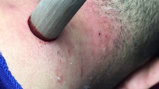 Acne pea  get pustules clean  Official Video [upl. by Sigfried]