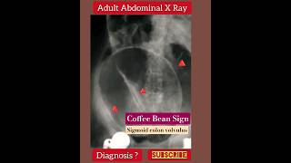 Coffee Bean Sign  Sigmoid colon volvulus  Abdominal X Ray  Radiology [upl. by Emmeline]