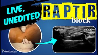 RAPTIR block start to finish Retroclavicular Approach to the Infraclavicular Region [upl. by Niala]