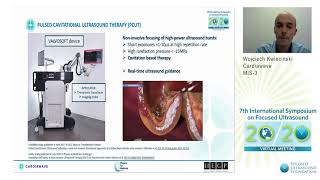 W Kwiecinski  Noninvasive Ultrasound Therapy of Calcific Aortic Stenosis FirstinHuman 2020 [upl. by Amimej]