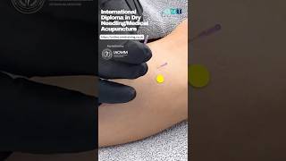 How to Needle Tibialis Anterior Correctly TibialisAnterior AcupunctureTechniques [upl. by Westerfield720]