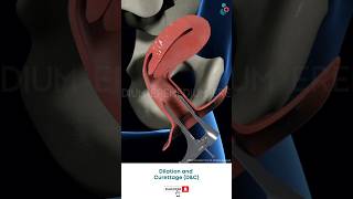 Dilation And Curettage DampC  Fertility Treatment ↪3D Medical Animation Shorts DilationampCurettage [upl. by Jankey]