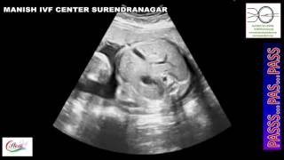 FETAL ECHOCARDIOGRAPHY AICOG 2017 [upl. by Anilat]