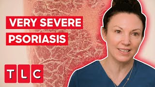 The Most Severe Case Of Psoriasis Dr Emma Has Ever Seen  The Bad Skin Clinic [upl. by Yntruoc]