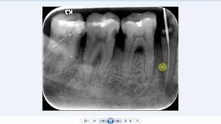 Is this the mental foramen or a periapical pathology [upl. by Alexei868]