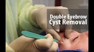 Double Eyebrow Cyst [upl. by Ardnasela]