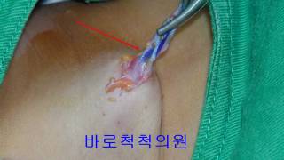 새열낭 branchial cleft cyst 鰓裂囊  전이개낭종preauricular sinus 수술하기 [upl. by Sukhum546]