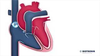 Sistema eléctrico del corazón  Animación médica [upl. by Lux]