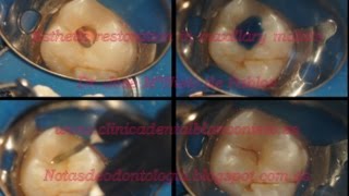 Endodoncia en 16 ProTaper Next [upl. by Aicekal]