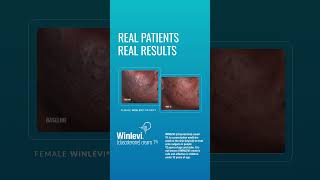 Real patients real results with WINLEVI® WINLEVI acnetreatment acne skincaretips [upl. by Nealson]