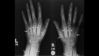 Radiology Hypertrophic osteoarthropathy concept for NEETPGFMGEINICETNEXT [upl. by Eissej]