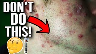 MUST WATCH BEFORE SHAVING WITH ACNE [upl. by Gatian3]