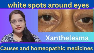 आंखों के आस पास चर्बी जमा होना xanthelesma cholestrol deposit homeopathic medicines [upl. by Tipton755]