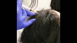 Stem Cells for Hair Loss [upl. by Freemon445]