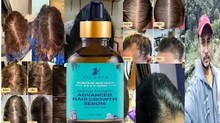 Pilgrim Redensyl Anagain Advanced Hair Growth Serum  Honest Review [upl. by Yelda]