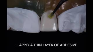 Porcelain Veneer Cementation step by step technique [upl. by Shermy895]