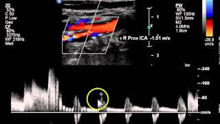 Bilateral ICA amp Unilateral Subclavian Stenosis  Case Study [upl. by Porty]