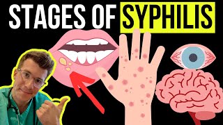 Doctor explains the Symptoms and Stages of SYPHILIS STI [upl. by Bruno]