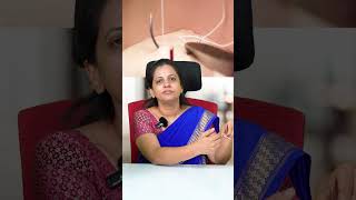 How Many Stitches Do You Get During Normal Delivery  Essential Tips  Dr Shilpa GB [upl. by Siol]