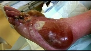 Pus Filled Blisters  Bizarre ER [upl. by Egrog322]