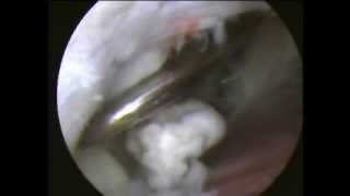 ELBOW ARTHROSCOPY loose body removal  Chondroplasty [upl. by Elehcim668]