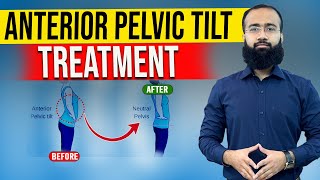 Get Rid Of Anterior Pelvic Tilt Fast With Easy Home Remedies [upl. by Refinej240]