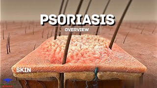 Psoriasis Overview [upl. by Vona]