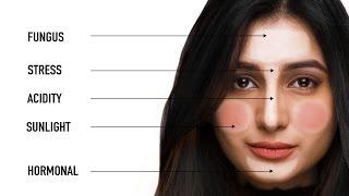 What Your Pimples Say About Your Health  Face Mapping with Dermatologist Bindu Sthalekar [upl. by Ahsakat]