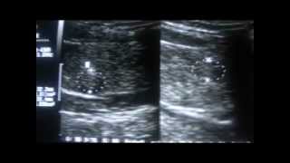 THYROID COLLOIDAL CYST or PARATHYROID GLAND HYPERPLASIA  part 1b [upl. by Putnam]