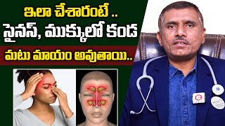 ముక్కులో కండ  Say Goodbye To Sinus And Nasal Polyps  Dr Ramana Raju  AROGYA MITRA [upl. by Swirsky]