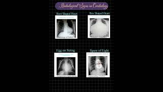 RADIOLOGICAL SIGNS IN CARDIOLOGY Mnemonic [upl. by Lorelei283]