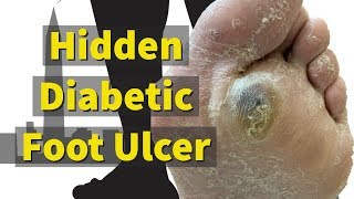 Hidden Diabetic Foot Ulcer [upl. by Ahtanoj]