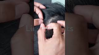 Lice and nits  ASMR SRI videoshorts [upl. by Ahsaeym]