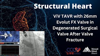 ViV TAVR with 26mm Evolut FX Valve in Degenerated Surgical Valve After Valve Fracture [upl. by Cadmar396]