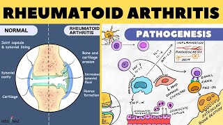 Rheumatoid Arthritis Pathophysiology  Rheumatoid Arthritis Pathogenesis  Arthritis pathophysiology [upl. by Ahsaz]