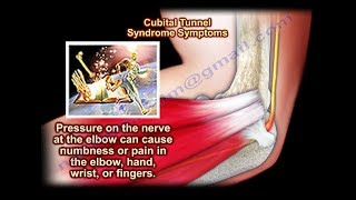 Cubital Tunnel Syndrome  Everything You Need To Know  Dr Nabil Ebraheim [upl. by Canice848]