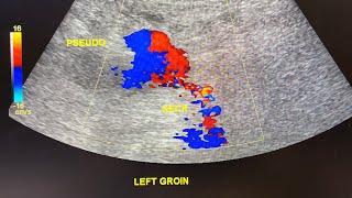 Ultrasound cases pseudoaneurysm  common femoral artery [upl. by Nnyw]