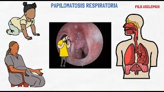 PAPILOMAS EN LA GARGANTA  PAPILOMATOSIS RESPIRATORIA RECURRENTE [upl. by Ajuna913]