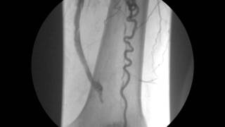 ANGIOPLASTIA CON STENT DE ARTERIA FEMORAL PROFUNDA 3 [upl. by Nosnirb]