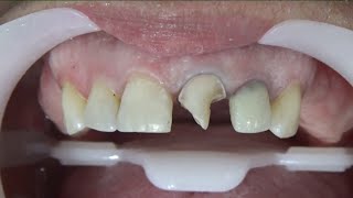 🔴PASSO A PASSO RECONTRUÇÃO DENTAL ESTRATIFICAÇÃO COMPLETA🤩🤩🤩🤩🤩 [upl. by Ludvig]