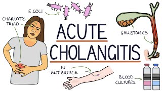 Understanding Acute Cholangitis Ascending Cholangitis [upl. by Ydaf882]