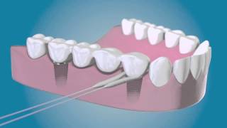 TePe Bridge amp Implant Floss  für die Reinigung um die Implantate [upl. by Yettie]